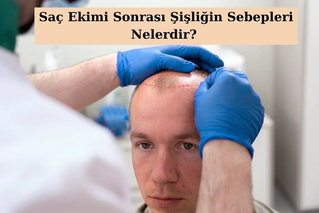Saç Ekimi Sonrası Şişlik Ve Ağrıyı Yönetmenin Etkili Yolları   Protez Saç Saç Ekiminde Ağrı Ve şişlik Oluşması